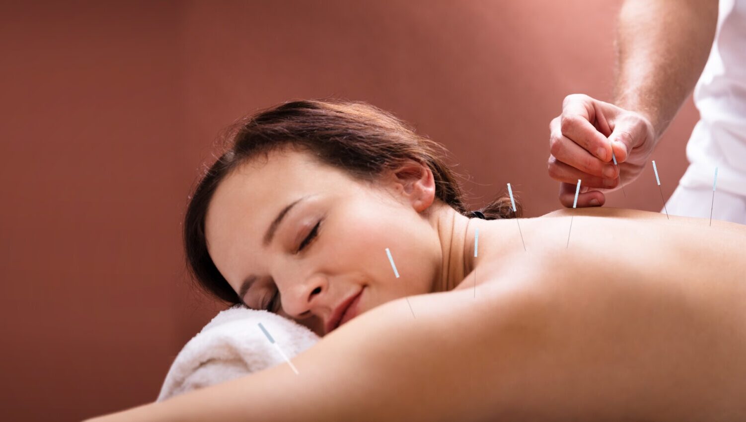 Woman receiving acupuncture with needles in her back, lying on a white towel.