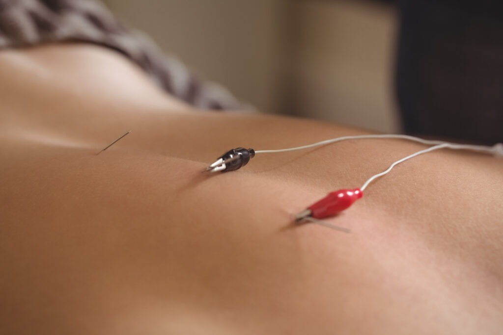 Close-up of patient getting electro dry needling on his back in clinic