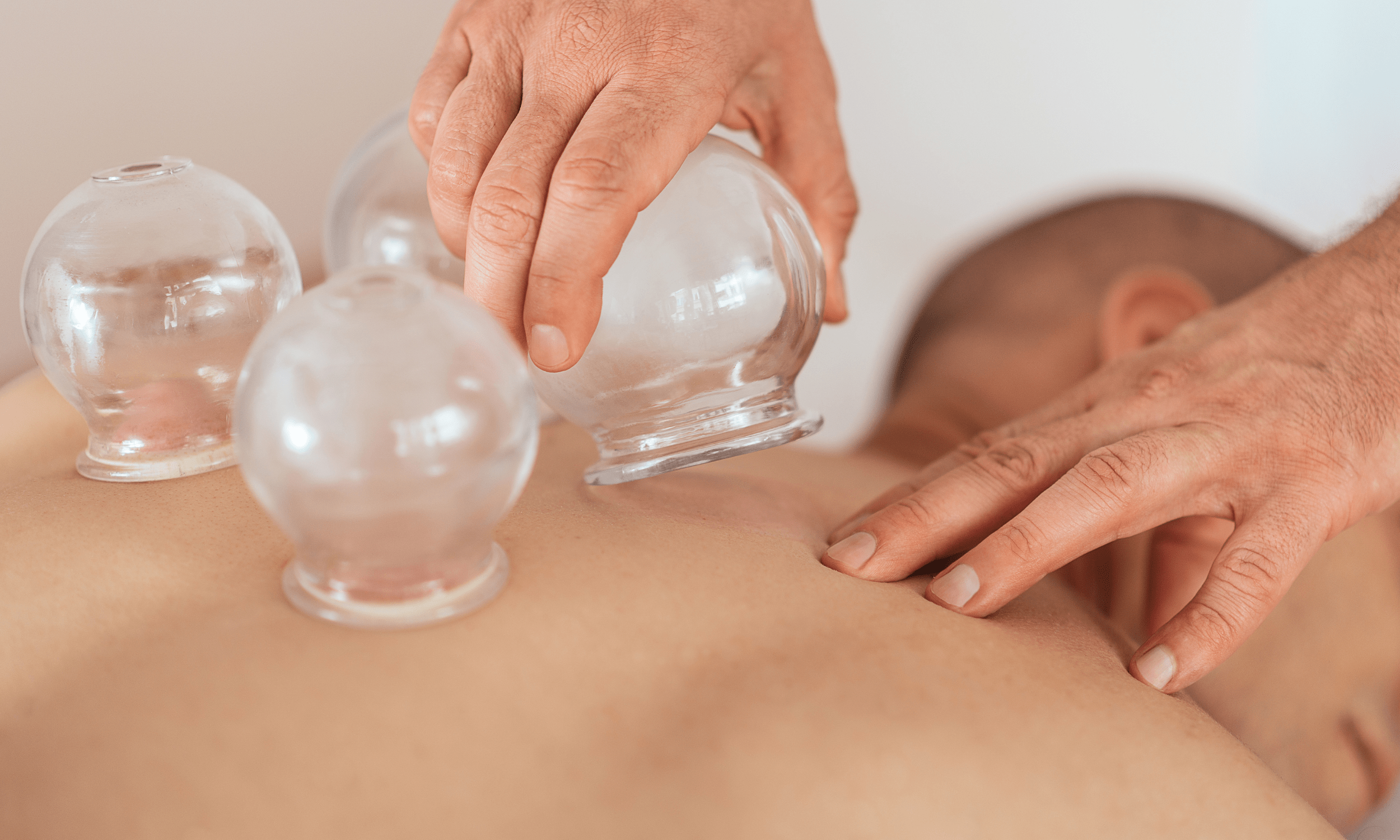 Man receiving cupping therapy with three transparent cups on her back.